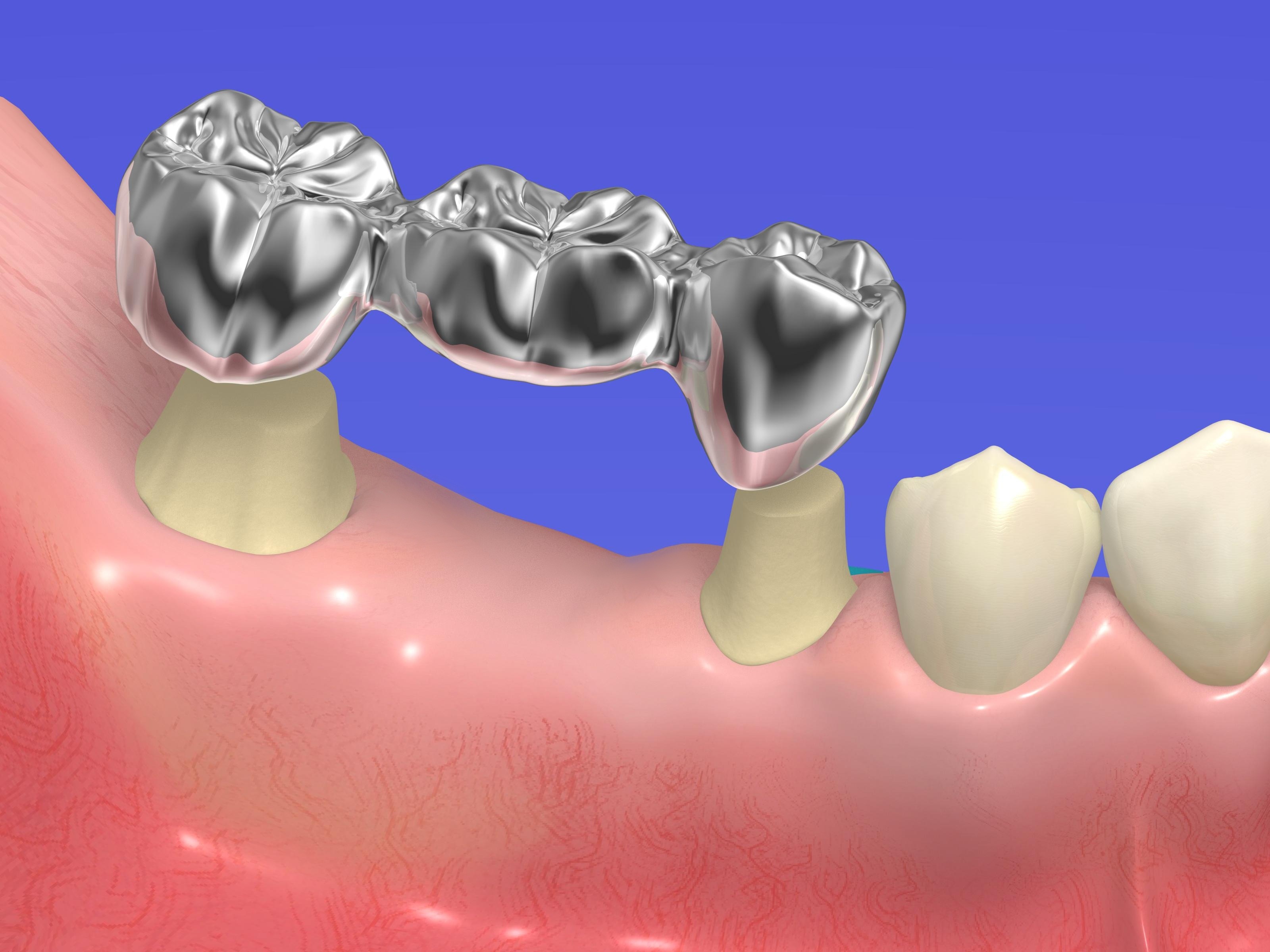 Способы восстановить утраченный зуб