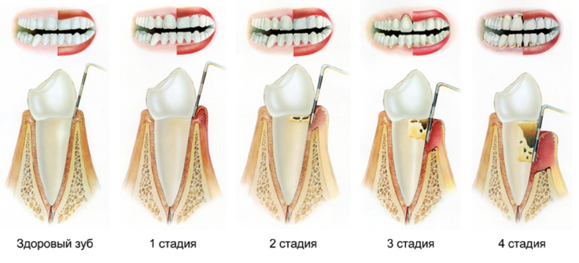Что такое пародонтит