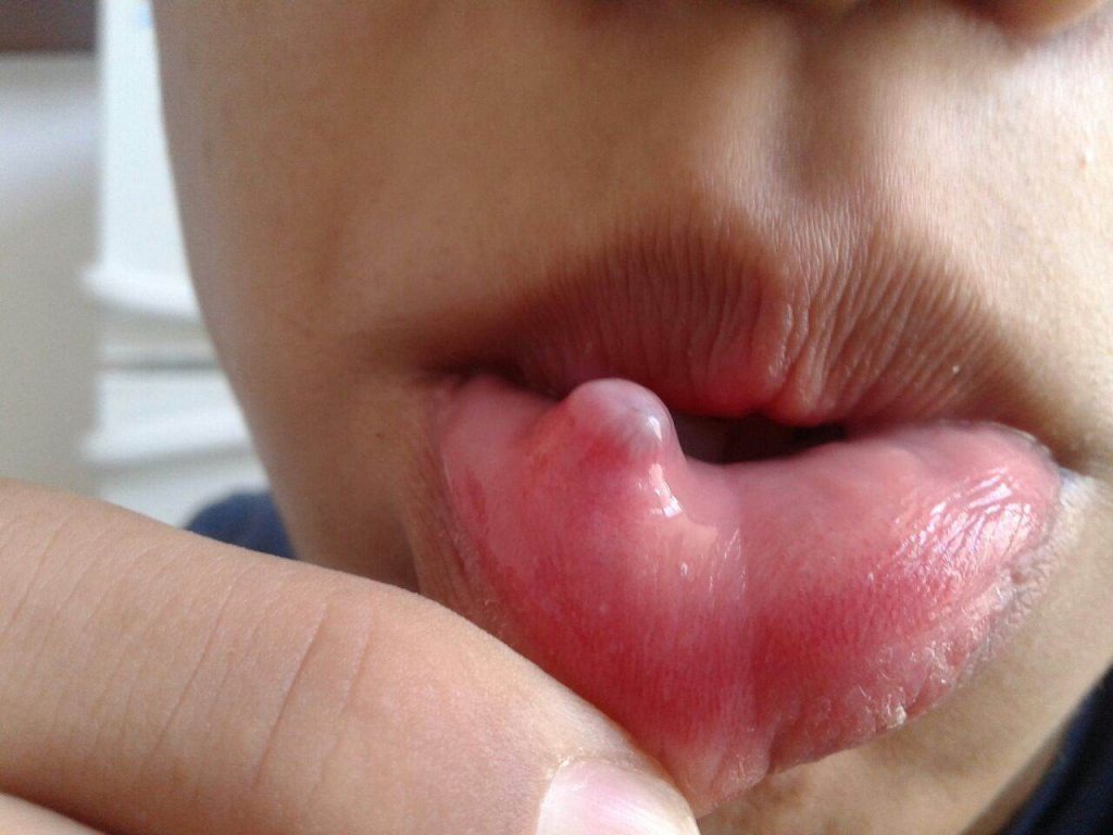 Воспаление полости рта (стоматит): причины, виды заболеваний и методы лечения