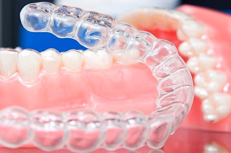 Как поставить элайнеры для исправления прикуса